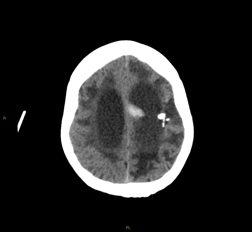 Basal ganglia hemorrhage (Radiopaedia 58766-65988 Axial non-contrast 19).jpg