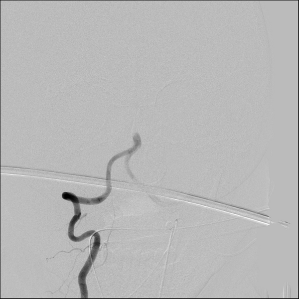 File:Basilar artery thrombosis treated with intra-arterial urokinase (Radiopaedia 34571-35949 A 11).png