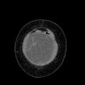 Benign leiomyoma with hydropic features (Radiopaedia 89250-106130 B 12).jpg