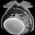 Benign seromucinous cystadenoma of the ovary (Radiopaedia 71065-81300 Coronal T2 12).jpg