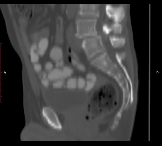 File:Bertolotti syndrome (Radiopaedia 58974-66235 Sagittal bone window 25).jpg