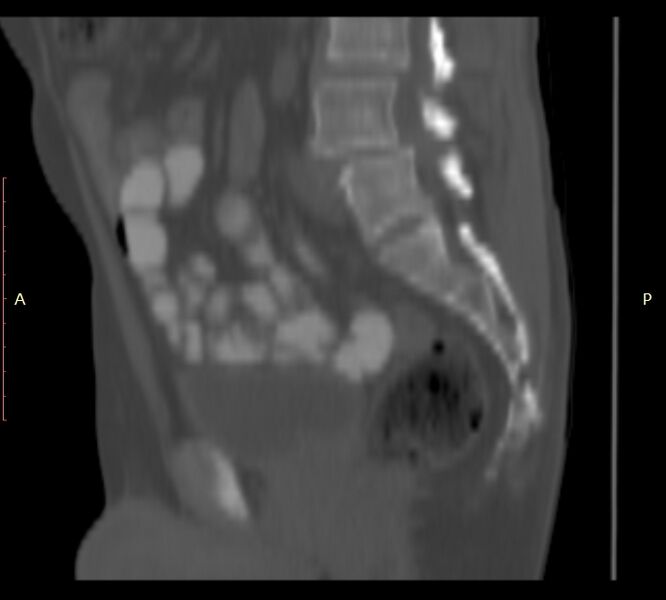 File:Bertolotti syndrome (Radiopaedia 58974-66235 Sagittal bone window 29).jpg