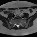 Bicornuate uterus (Radiopaedia 72135-82643 Axial T2 1).jpg