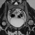Bicornuate uterus (Radiopaedia 72135-82643 Coronal T2 6).jpg