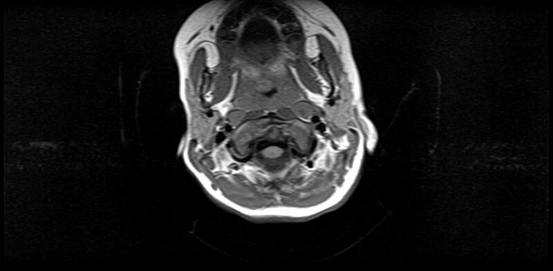 File:Bilateral Sprengel deformity with Klippel-Feil syndrome (Radiopaedia 66395-75650 Axial T1 5).jpg