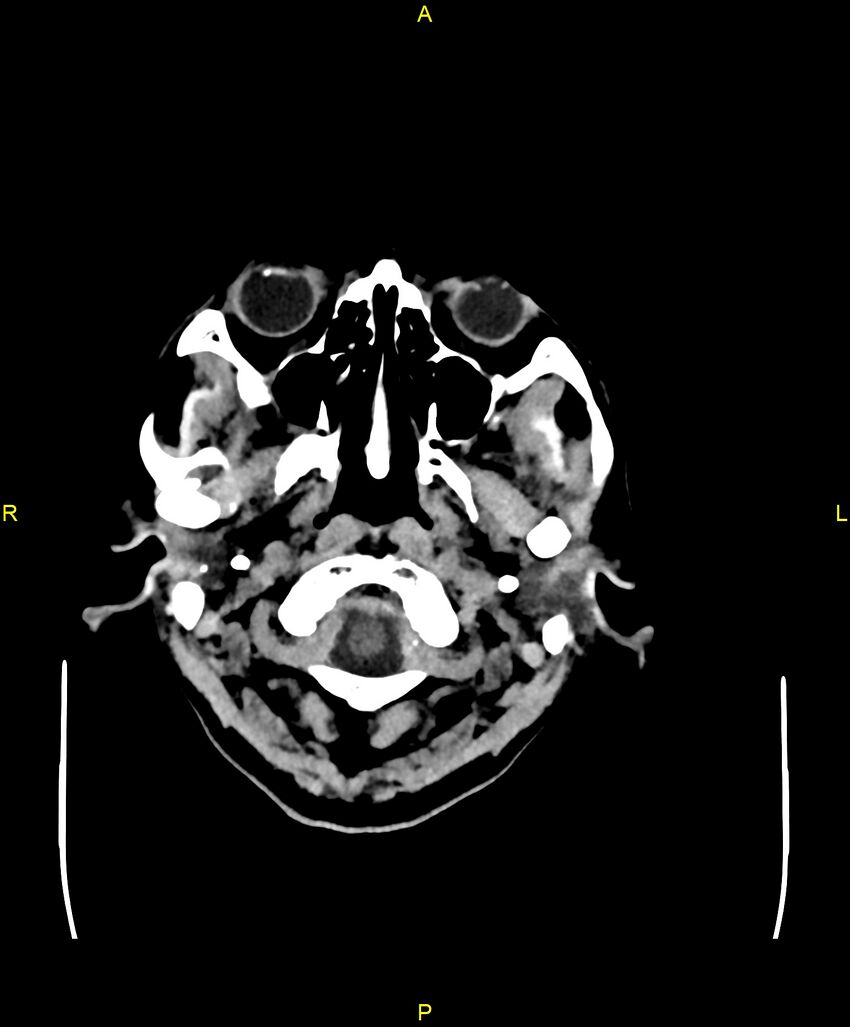 Bilateral isodense subdural hematomas (Radiopaedia 88621-105325 Axial non-contrast 4).jpg