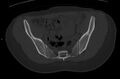 Bilateral mature cystic ovarian teratoma (Radiopaedia 88821-105592 Axial bone window 1).jpg