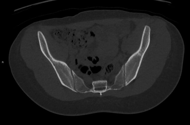 File:Bilateral mature cystic ovarian teratoma (Radiopaedia 88821-105592 Axial bone window 1).jpg