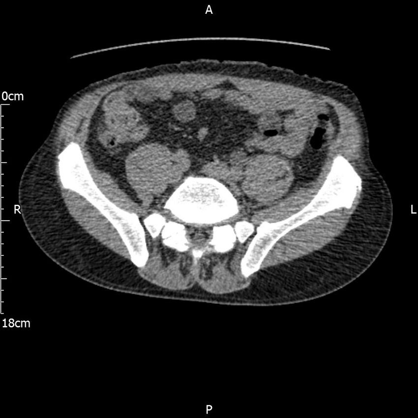 Bilateral medullary nephrocalcinosis with ureteric calculi (Radiopaedia 71269-81569 Axial non-contrast 91).jpg
