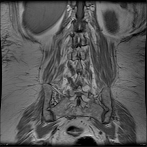 File:Bilateral psoas hematomas (Radiopaedia 24057-24280 B 5).jpg