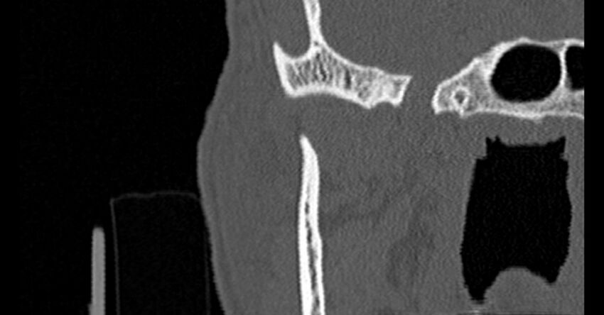Bilateral temporal bone fractures (Radiopaedia 29482-29970 Coronal non-contrast 17).jpg