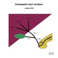 Biliary duct anatomic variation (diagram) (Radiopaedia 70380-80479 Intrahepatic ducts 3).jpeg