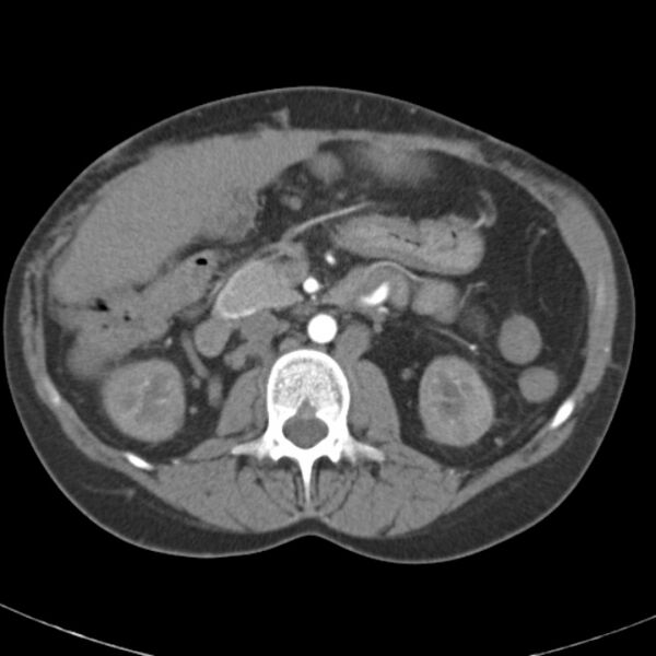 File:Biliary necrosis - liver transplant (Radiopaedia 21876-21845 A 27).jpg