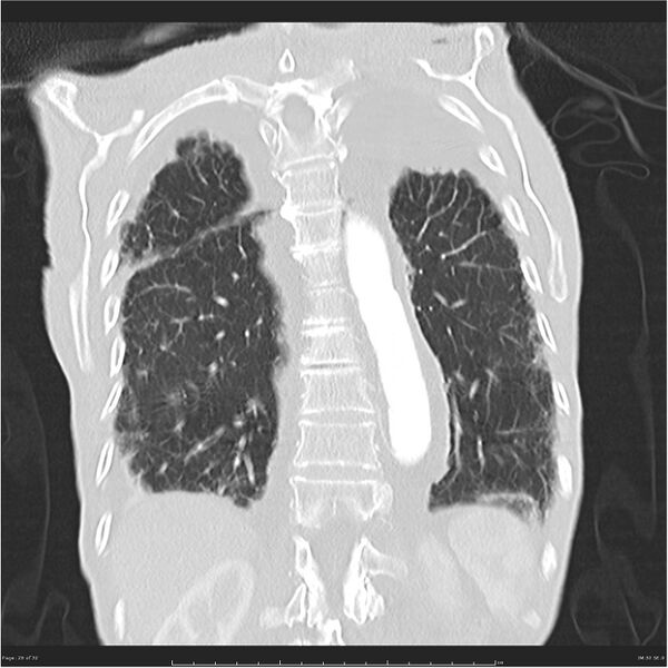 File:Boerhaave syndrome (Radiopaedia 26240-26362 Coronal lung window 26).jpg