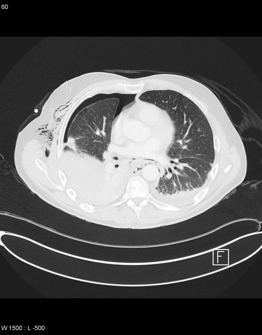 Boerhaave syndrome with tension pneumothorax (Radiopaedia 56794-63605 Axial lung window 29).jpg