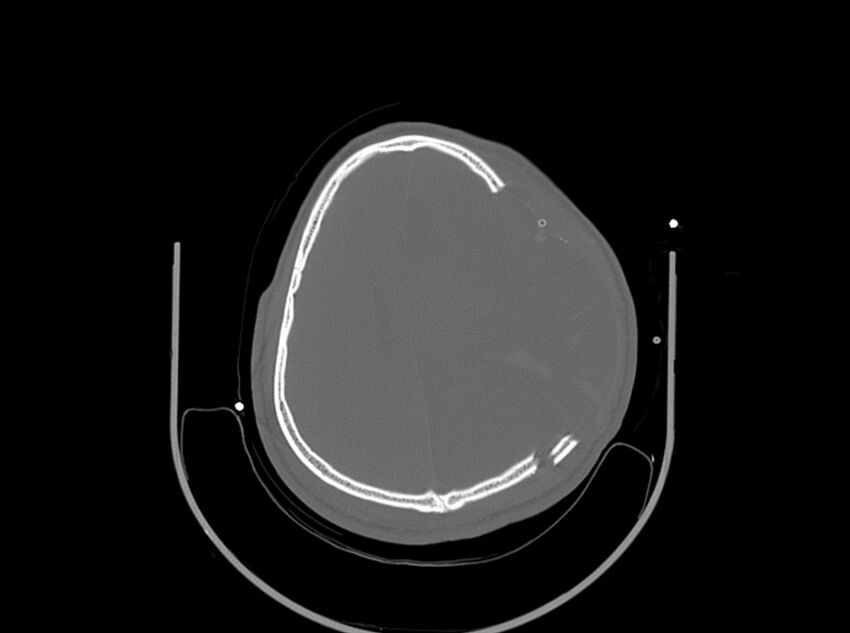 Brain injury by firearm projectile (Radiopaedia 82068-96087 A 130).jpg