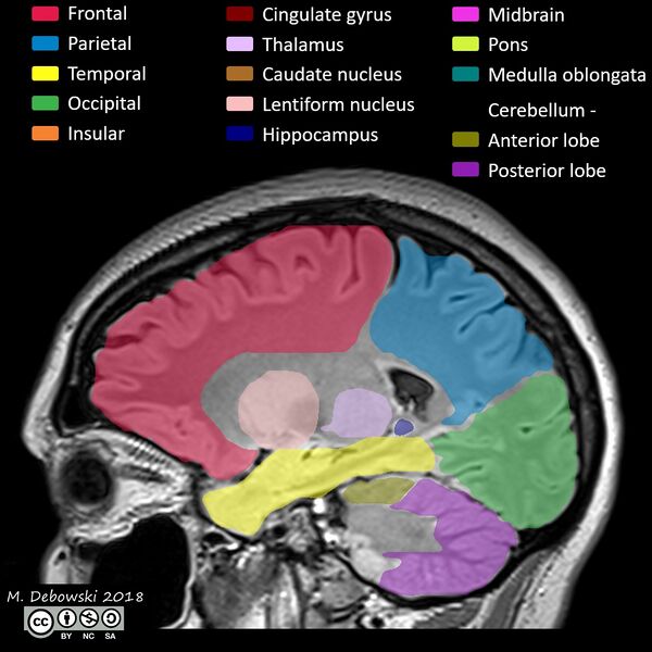 File:Brain lobes - annotated MRI (Radiopaedia 61691-69700 Sagittal 52).JPG