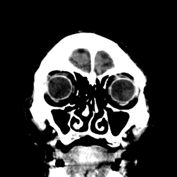File:Brain metastases from lung cancer (Radiopaedia 27849-28092 Coronal C+ delayed 8).jpg