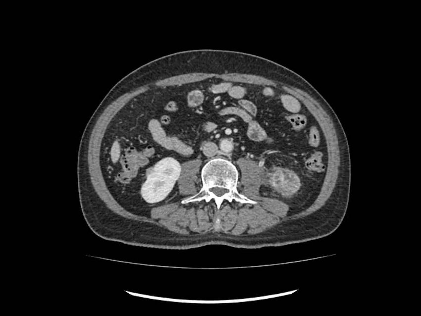 Brain metastases from renal cell carcinoma (Radiopaedia 42222-45328 B 151).jpg