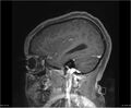 Brainstem glioma (Radiopaedia 21819-21775 D 10).jpg