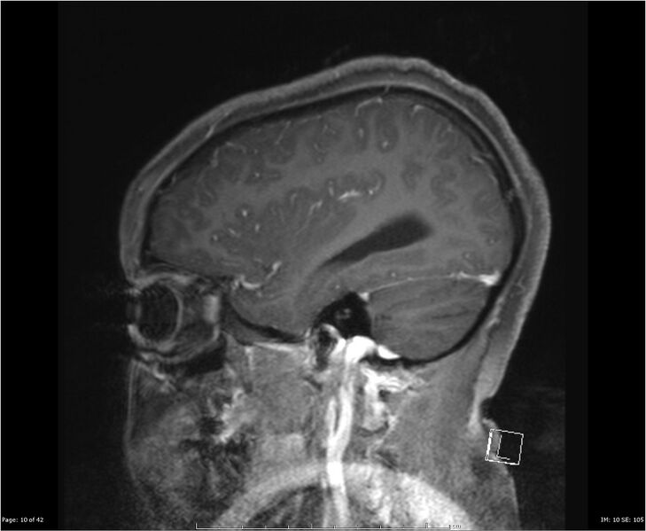 File:Brainstem glioma (Radiopaedia 21819-21775 D 10).jpg