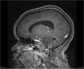 Brainstem glioma (Radiopaedia 21819-21775 D 17).jpg