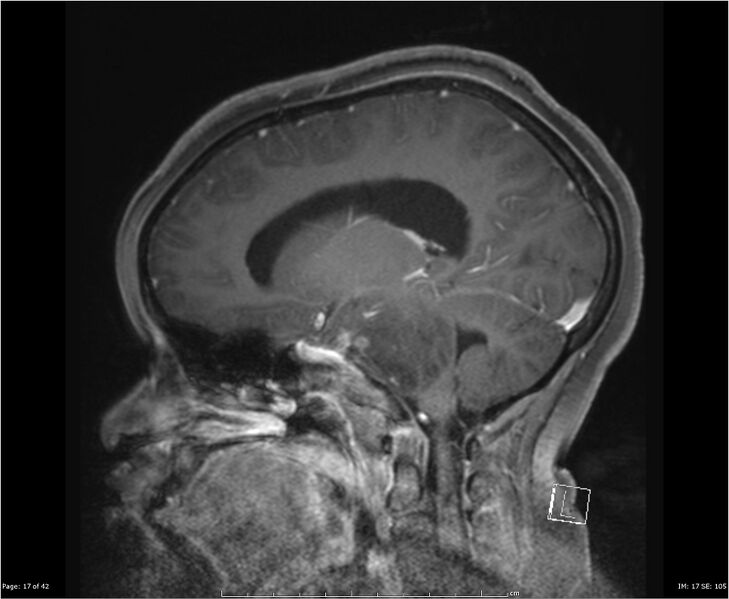 File:Brainstem glioma (Radiopaedia 21819-21775 D 17).jpg