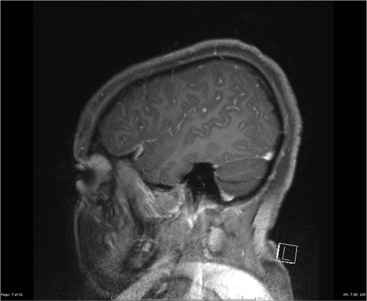 File:Brainstem glioma (Radiopaedia 21819-21775 D 7).jpg
