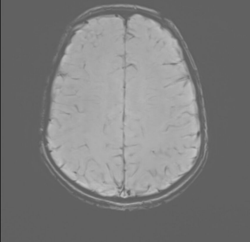 Brainstem glioma (Radiopaedia 70548-80674 Axial SWI 45).jpg