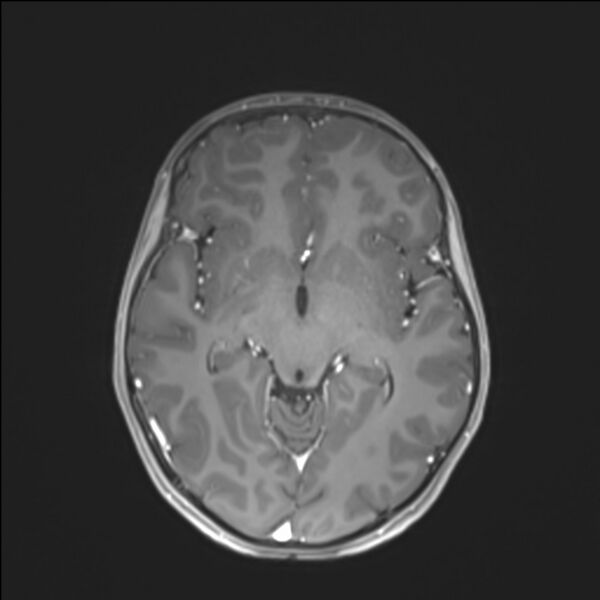 File:Brainstem glioma (Radiopaedia 70548-80674 Axial T1 C+ 75).jpg
