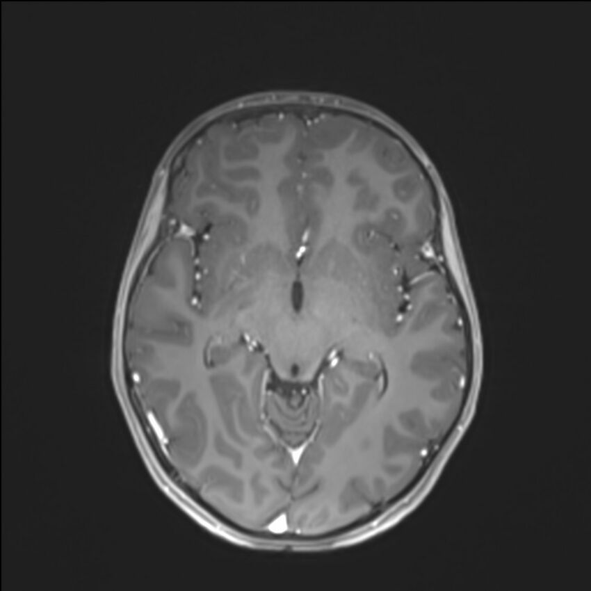 Brainstem glioma (Radiopaedia 70548-80674 Axial T1 C+ 75).jpg