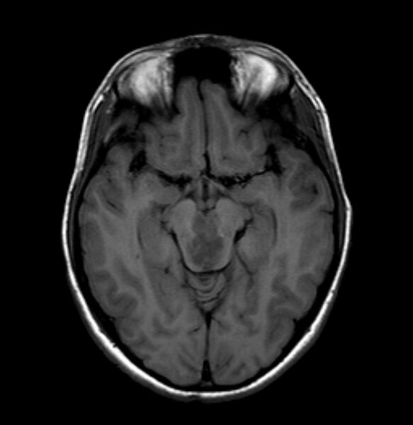 File:Brainstem glioma - focal midbrain (Radiopaedia 6525-7840 Axial T1 1).jpg