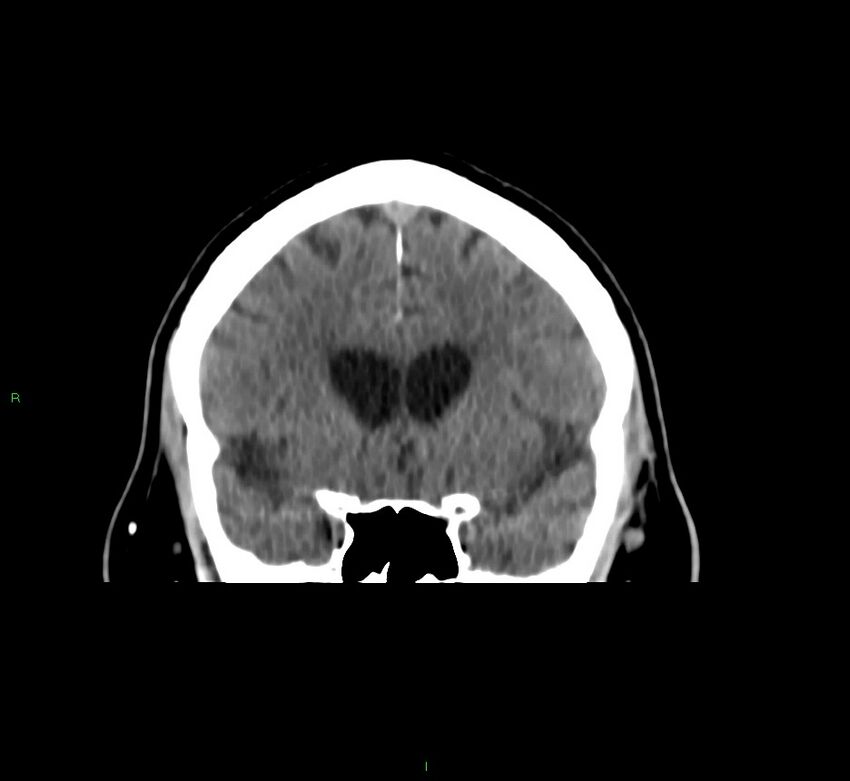 Brainstem hemorrhage (Radiopaedia 58794-66028 Coronal non-contrast 43).jpg