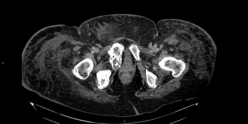 Breast cancer pelvic bony metastases (Radiopaedia 84470-99824 Axial bone window 67).jpg