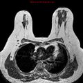 Breast carcinoma (multicentric multifocal in mammary Paget disease) (Radiopaedia 50966-56512 Axial T1 12).jpg