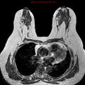 Breast carcinoma (multicentric multifocal in mammary Paget disease) (Radiopaedia 50966-56512 Axial T1 8).jpg