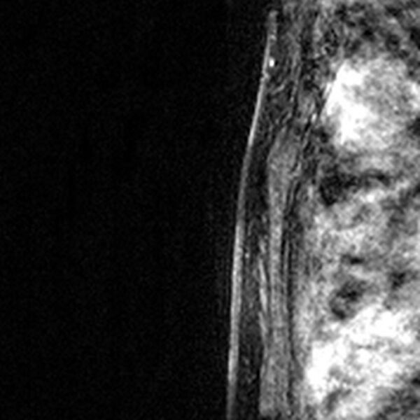 File:Breast implants - MRI (Radiopaedia 26864-27035 Sagittal T2 63).jpg
