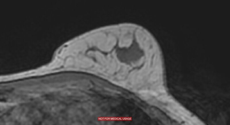 File:Breast lymphoma (MRI) (Radiopaedia 34999-36498 Axial T1 21).jpg