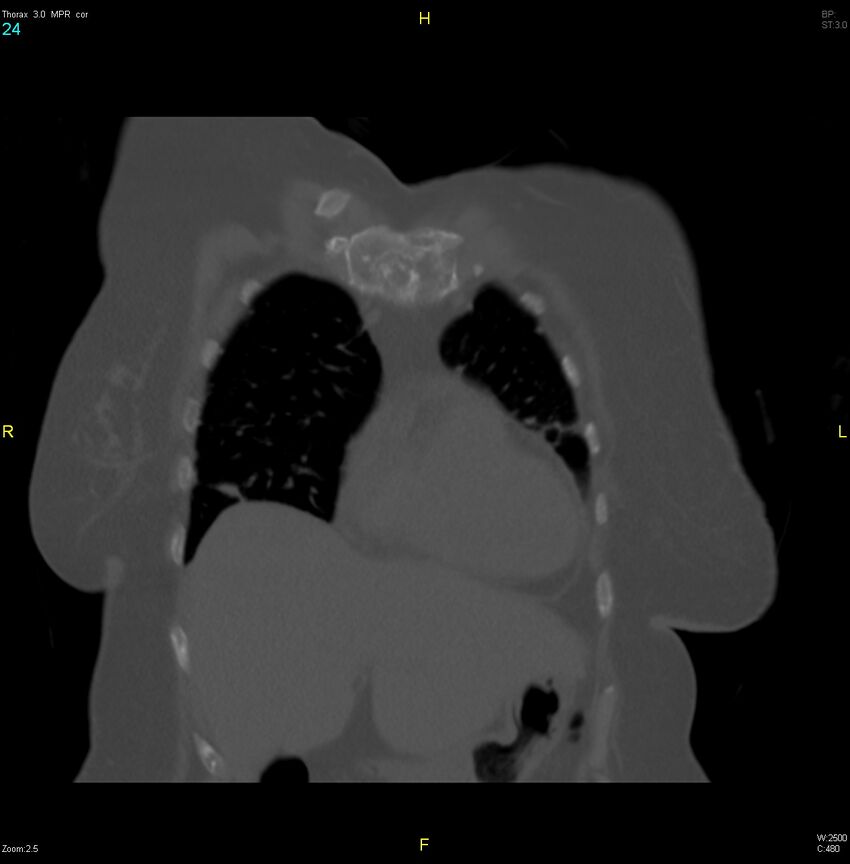 Breast primary with lung and bone metastases (Radiopaedia 40620-43228 bone window 24).jpg