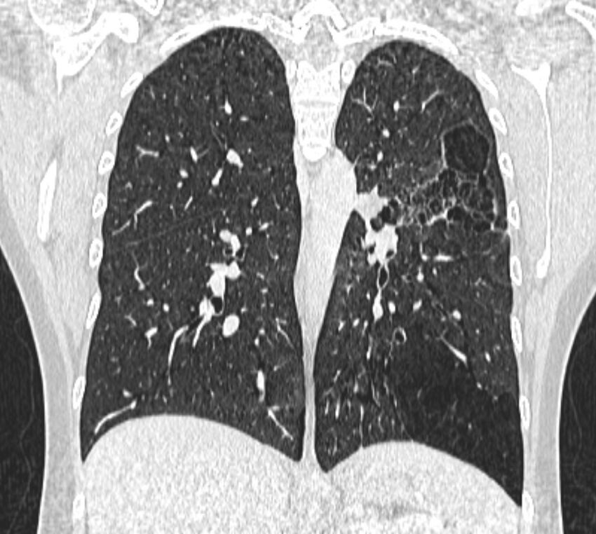 Bronchial atresia (Radiopaedia 50007-55297 Coronal lung window 70).jpg