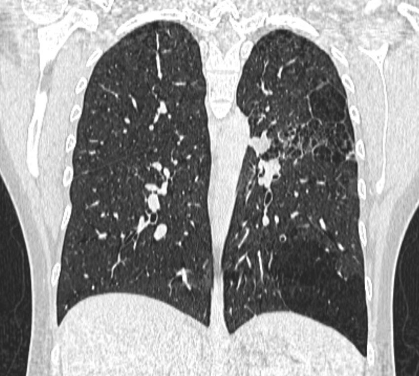 Bronchial atresia (Radiopaedia 50007-55297 Coronal lung window 71).jpg