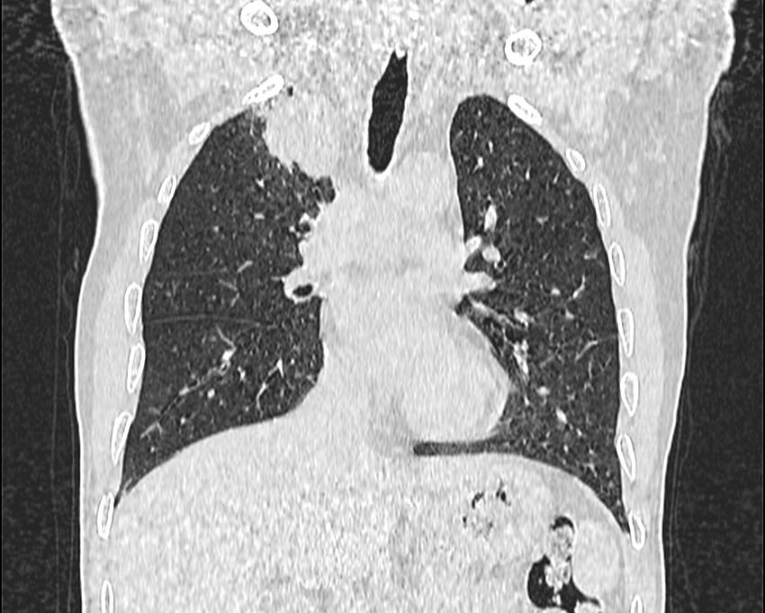 Bronchogenic carcinoma with superior vena cava syndrome (Radiopaedia 36497-38054 Coronal lung window 29).jpg