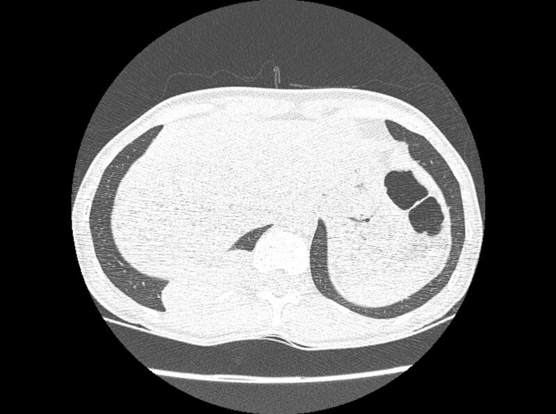 File:Bronchogenic cyst (Radiopaedia 80273-93615 Axial lung window 37).jpg