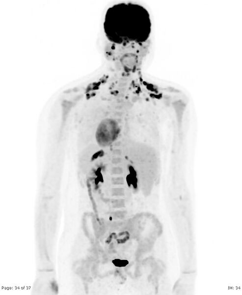 File:Brown fat uptake (FDG PET-CT) (Radiopaedia 77392-89513 MIP 33).jpg