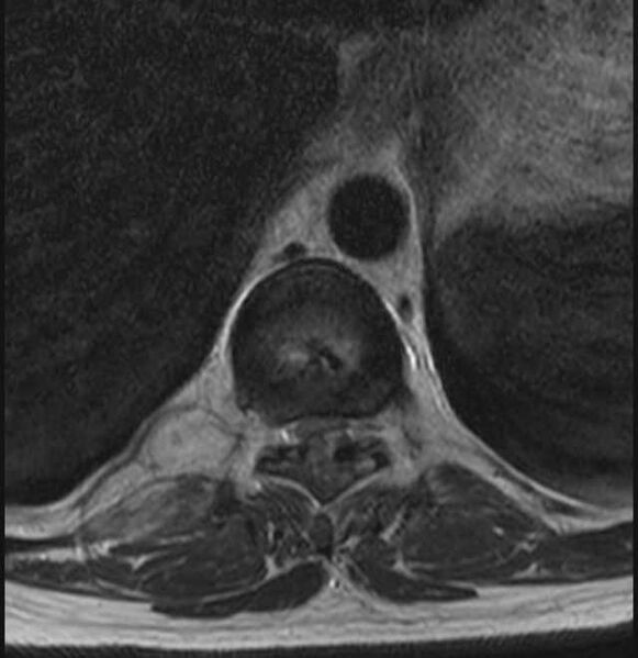 File:Brown tumors compressing the spinal cord (Radiopaedia 68442-78030 A 14).jpg
