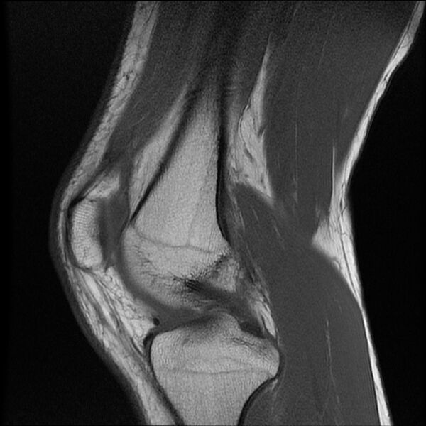 File:Bucket-handle meniscus tear (Radiopaedia 65700-74809 Sagittal T1 10).jpg