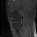 Bucket handle tear - lateral meniscus (Radiopaedia 7246-8187 Sagittal T2 fat sat 19).jpg