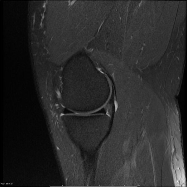File:Bucket handle tear - lateral meniscus (Radiopaedia 7246-8187 Sagittal T2 fat sat 19).jpg