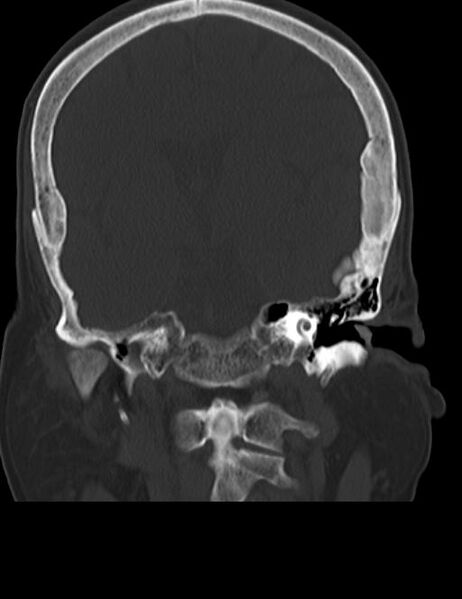 File:Burnt-out meningioma (Radiopaedia 51557-57337 Coronal bone window 27).jpg