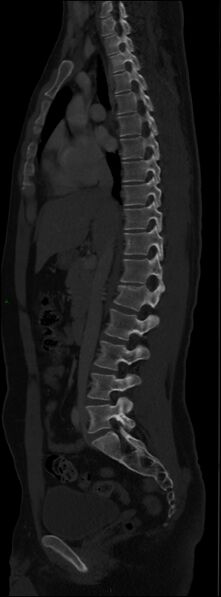 File:Burst fracture (Radiopaedia 83168-97542 Sagittal bone window 63).jpg